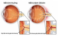 HƯỞNG ỨNG TUẦN LỄ GLÔCÔM THẾ GIỚI NĂM 2025 - ĐOÀN KẾT ĐỂ THẾ GIỚI HẾT BỆNH GLÔCÔM