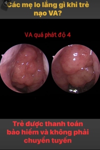 Bệnh viêm mũi (VA) ở trẻ