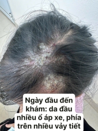 TRUNG TÂM Y TẾ HẢI HÀ ĐIỀU TRỊ THÀNH CÔNG BỆNH DA LIỄU (KERION DE CELSE)
