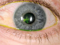 VIÊM GIÁC MẠC DO VIRUS HERPES