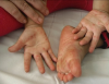 Những dấu hiệu trở nặng của trẻ mắc tay chân miệng, cha mẹ lưu ý