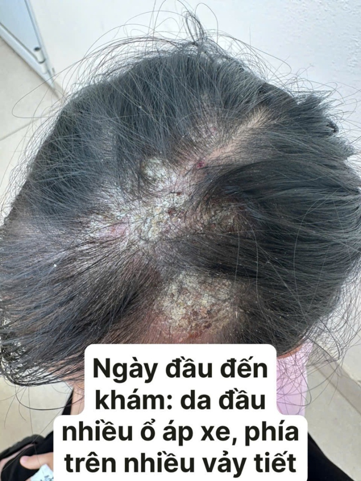 TRUNG TÂM Y TẾ HẢI HÀ ĐIỀU TRỊ THÀNH CÔNG BỆNH DA LIỄU (KERION DE CELSE)