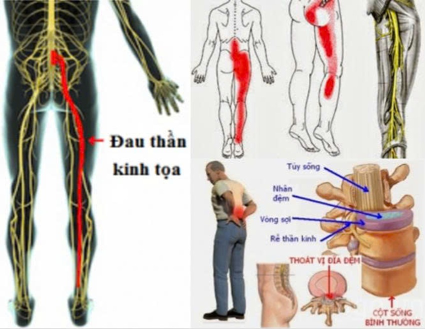 THOÁT VỊ ĐĨA ĐỆM CỘT SỐNG THẮT LƯNG