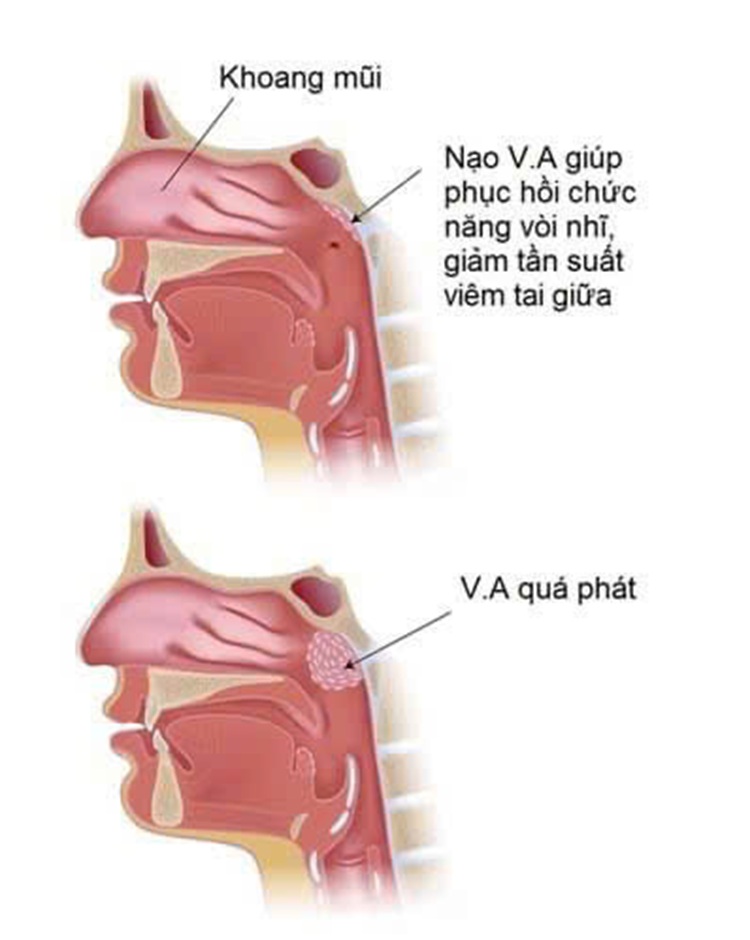 Phẫu thuật Nạo VA tại Trung tâm Y tế Hải Hà